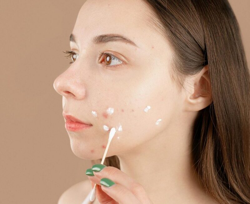 Can You Leave Toothpaste on a Pimple Overnight to Heal It