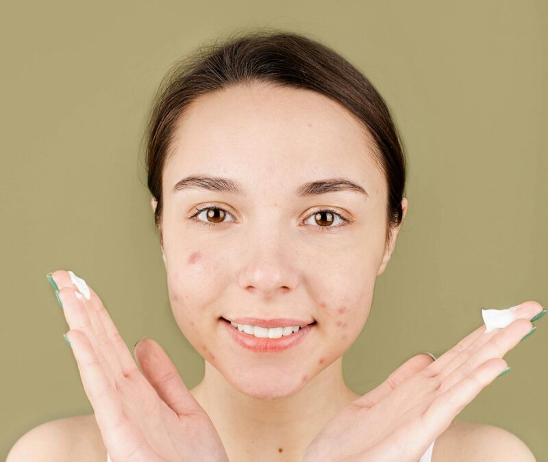 Common Causes of Acne and How to Identify Them